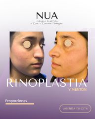 Rinoplastia - Dra. Daniela Ferreyra