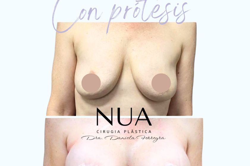 Mastopexia antes y después - 880421