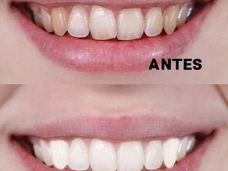 3 Doctores De Blanqueamiento Dental En Villa Alemana Clinicasesteticas Cl