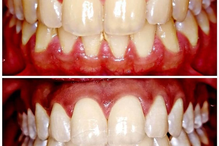 Blanquear dientes antes y después - 642677