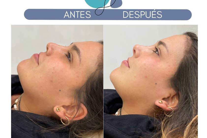 Rinomodelación antes y después - 856799