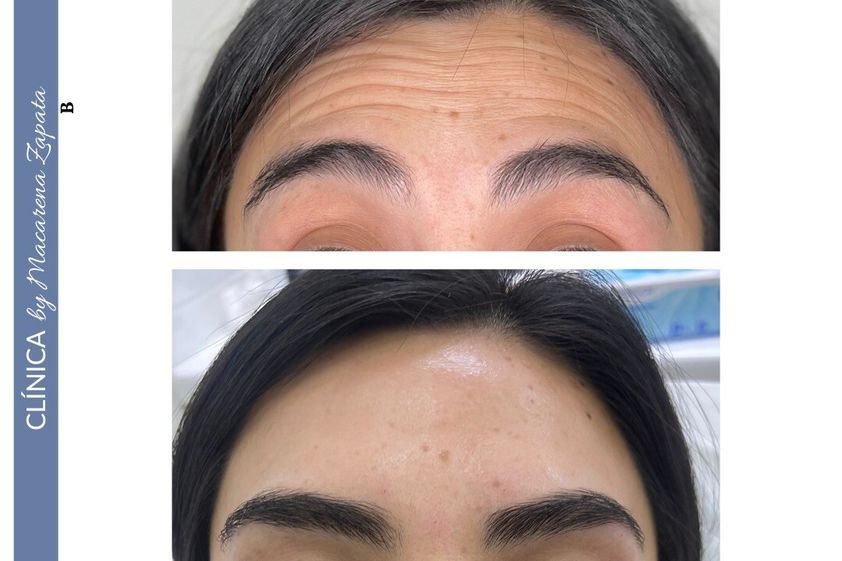 Bótox antes y después - 856800