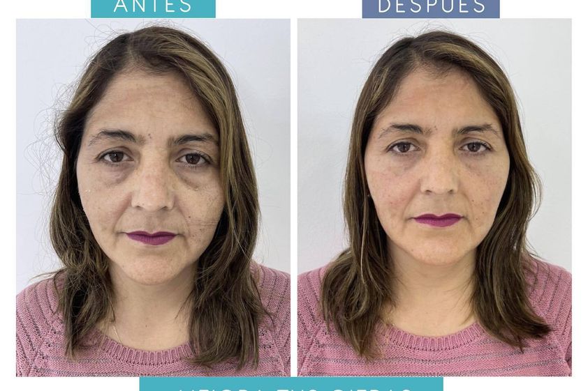 Tratamiento de ojeras antes y después - 856802