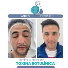 Toxina Botulínica - Clínica Aesthetic