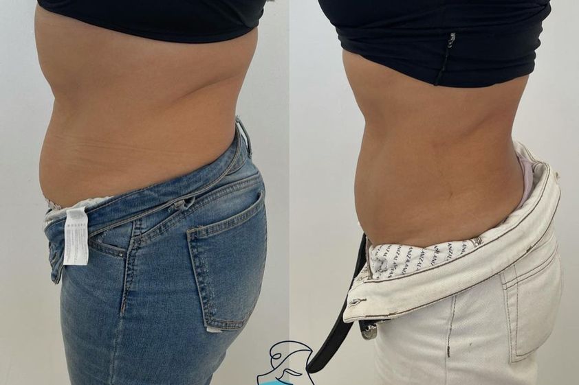 Tratamiento celulitis antes y después - 856806
