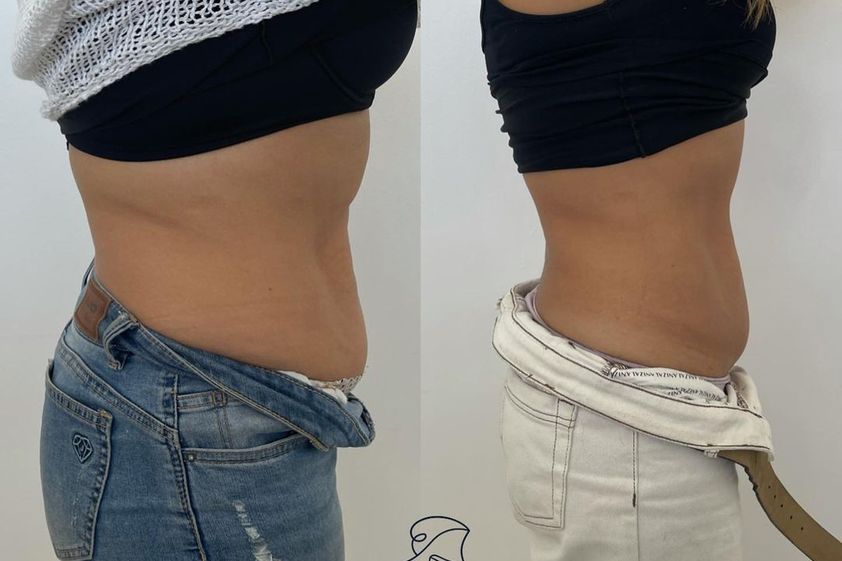 Tratamiento celulitis antes y después - 856807