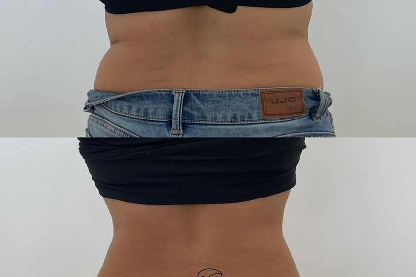 Tratamiento celulitis antes y después - 856808