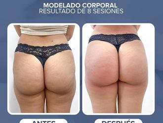 Tratamiento celulitis antes y después - 856809