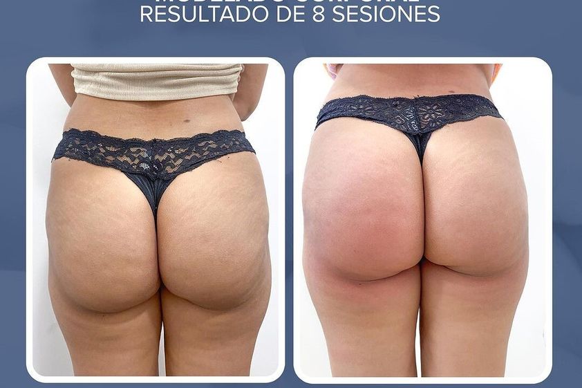 Tratamiento celulitis antes y después - 856809