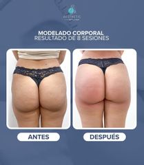 Tratamiento celulitis - Clínica Aesthetic