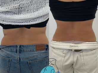Tratamiento celulitis antes y después - 856816
