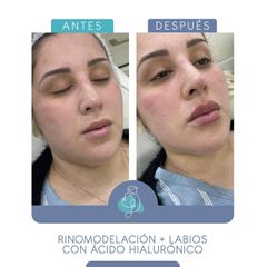 Aumento de labios - Clínica Aesthetic