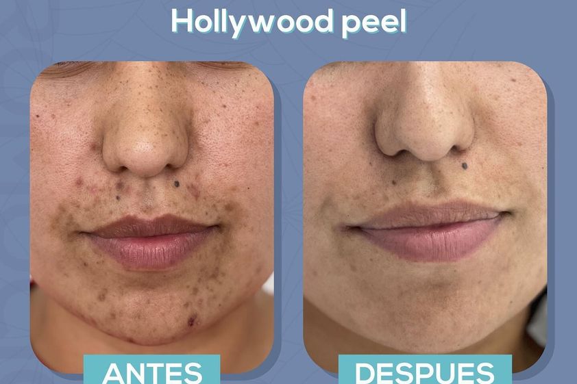 Peeling antes y después - 856818
