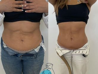 Tratamiento celulitis antes y después - 856819