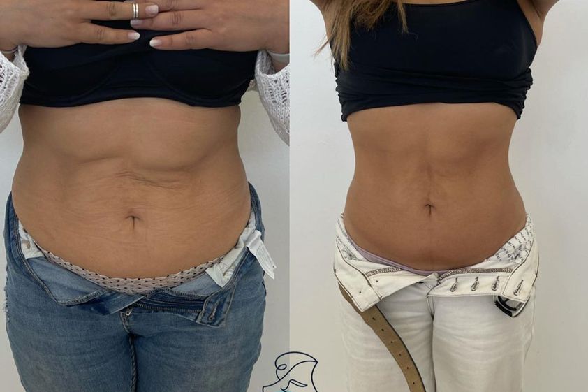 Tratamiento celulitis antes y después - 856819