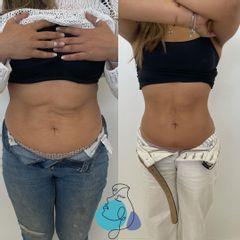 Tratamiento celulitis - Clínica Aesthetic