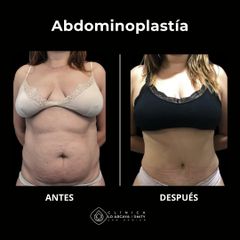Abdominoplastía - Clínica Lo Arcaya Unity