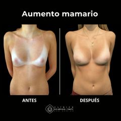Aumento mamario - Clínica Lo Arcaya Unity