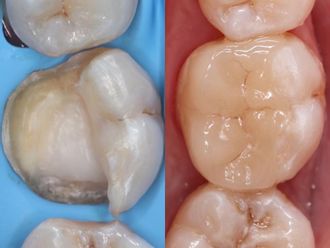 Prótesis dentales - 823503
