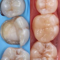 Prótesis dental - Clínica Oi