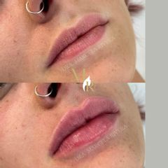 Aumento de labios - Dra. Marcela Rivera
