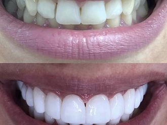 Blanquear dientes-693742