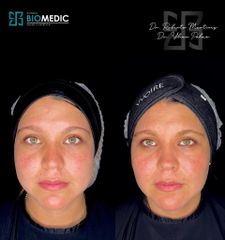 Armonización facial - Clínica Biomedic