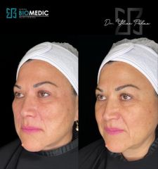 Armonización facial - Clínica Biomedic