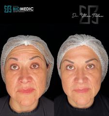 Armonización facial - Clínica Biomedic