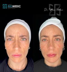 Armonización facial - Clínica Biomedic