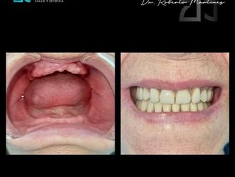 Implantes dentales - 831299