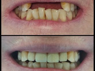 Implantes dentales - 831300