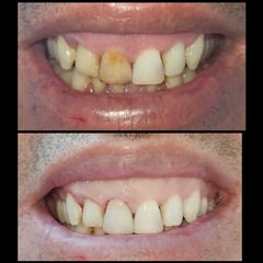 Blanqueamiento dental - Clínica Biomedic