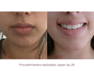 Upper lip lift