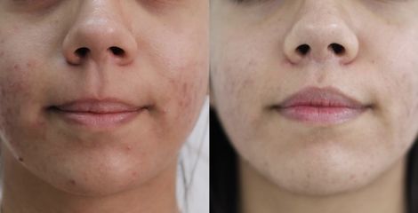 Upper Lip Lift -  Dr Rodrigo Ruiz - RR Clinica