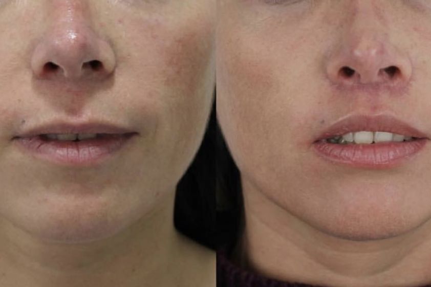 Aumento de labios antes y después - 824951