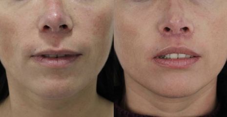 Upper Lip Lift - Dr Rodrigo Ruiz - RR Clinica