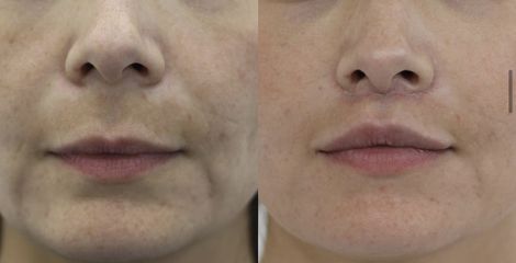 Upper lip lift - Dr Rodrigo Ruiz - RR Clinica