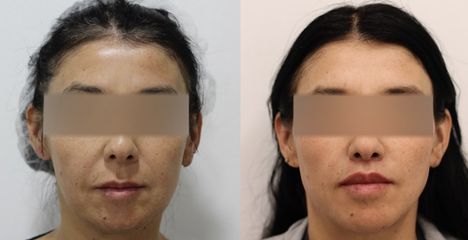 Upper Lip Lift - Dr Rodrigo Ruiz - RR Clinica