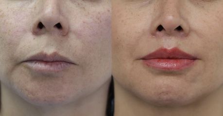 Upper Lip Lift - Dr Rodrigo Ruiz - RR Clinica