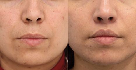 Upper Lip Lift - Dr Rodrigo Ruiz - RR Clinica