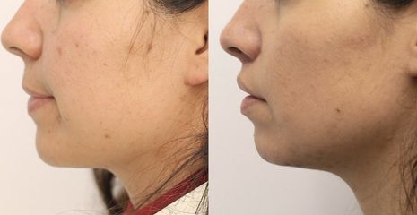 Upper lip lift - Dr Rodrigo Ruiz - RR Clinica