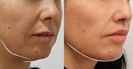 Upper Lip Lift - Dr Rodrigo Ruiz - RR Clinica