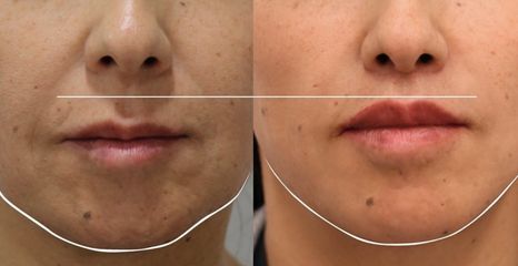 Upper Lip Lift - Dr Rodrigo Ruiz - RR Clinica