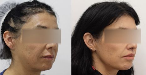 Upper Lip Lift - Dr Rodrigo Ruiz - RR Clinica