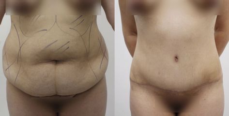 Abdominoplastia - Dr Rodrigo Ruiz - RR Clinica