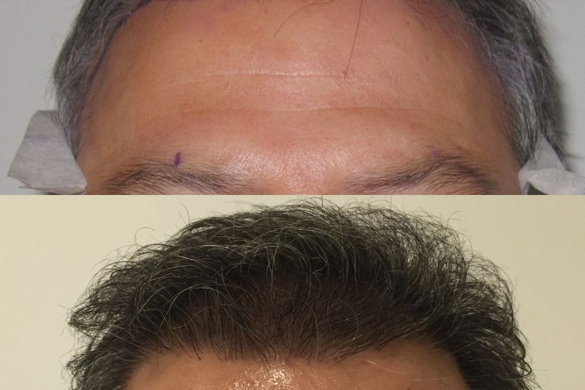 Implante Capilar antes y después - 826559