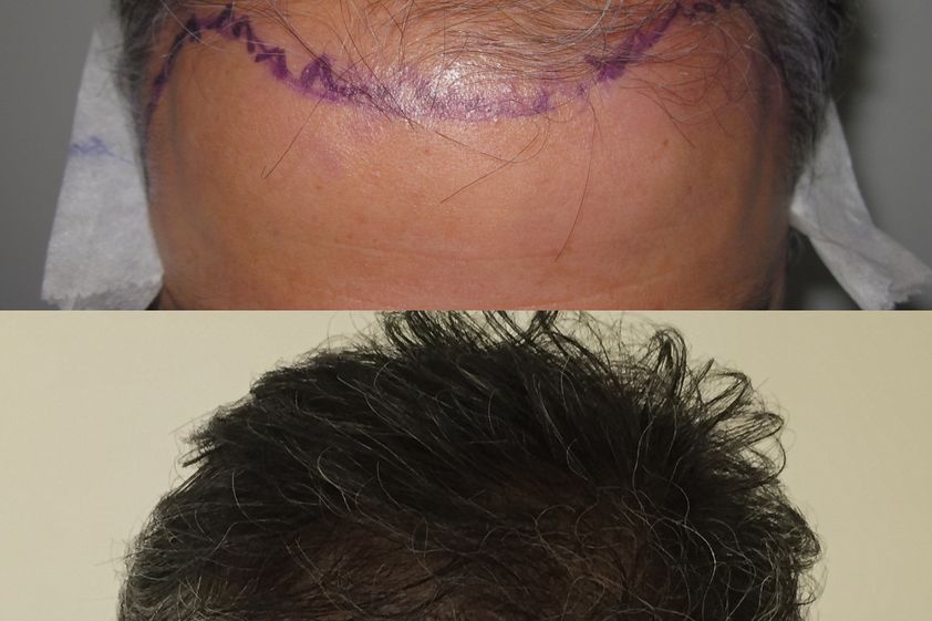 Implante Capilar antes y después - 826560