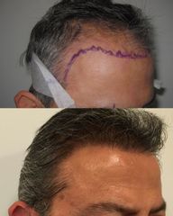 Implante Capilar - Dr Rodrigo Ruiz - RR Clinica