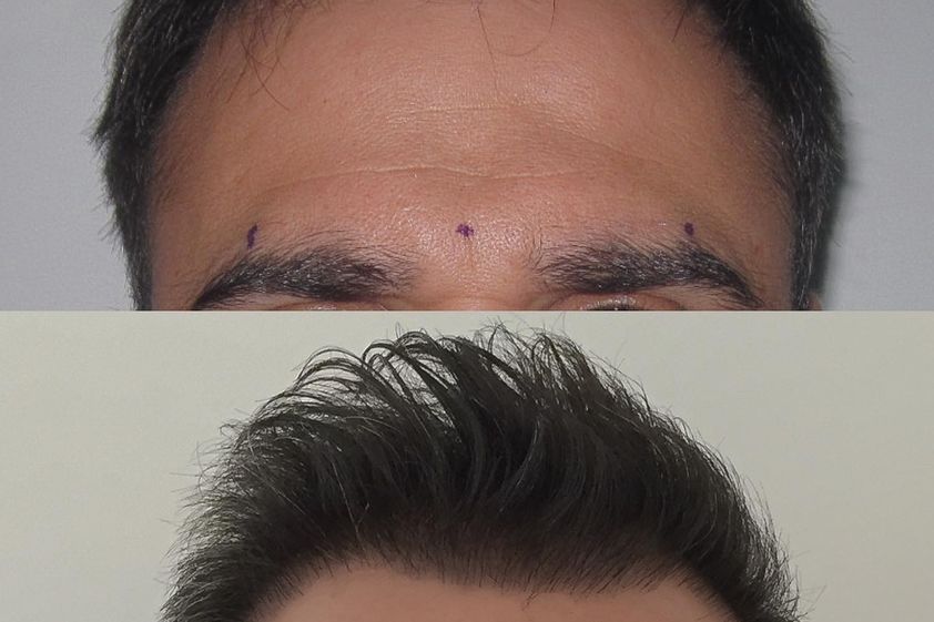 Implante Capilar antes y después - 826565